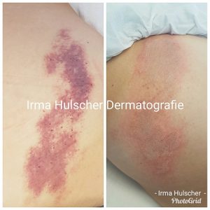 Irma Hulscher PMU en Dermatografie