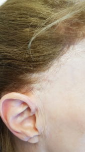FFA Frontale Fibroserende Alopecia Hulscher Cosmetics